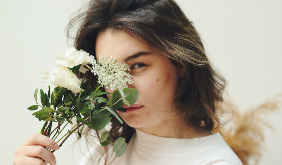 articulo acne